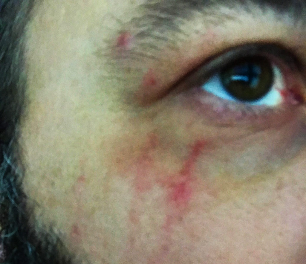 scratch near eye after being attacked by my angry son